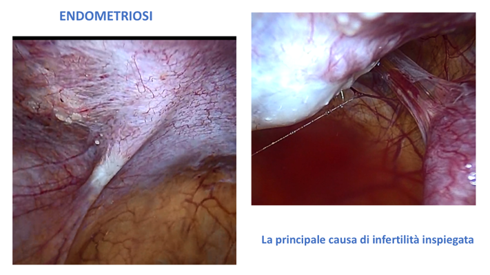 endometriosi